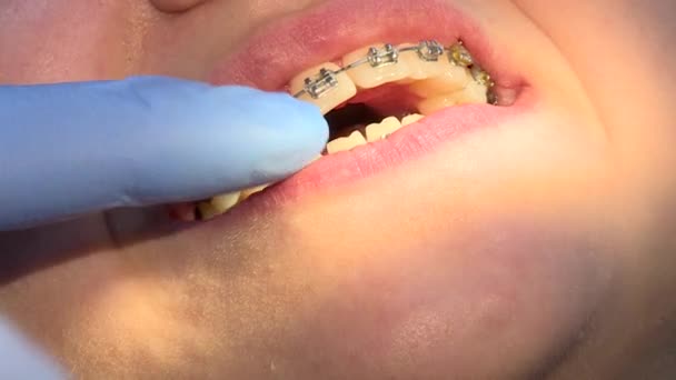 El dentista toma una huella de los dientes. Funciona con implantes. Cambiar aparatos ortopédicos - Metraje, vídeo