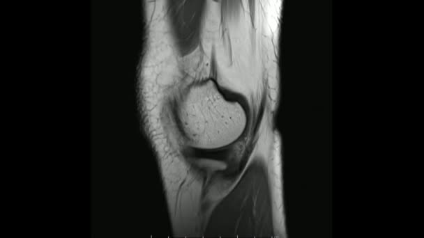 Imágenes de resonancia magnética de la articulación de la rodilla Sagittal T1- weighted Images in cine mode (MRI Knee joint) showing the anatomy of the knee - Metraje, vídeo