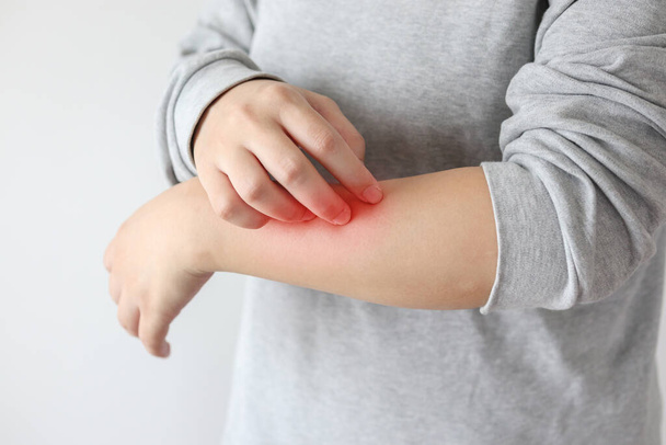 Junge asiatische Frau juckt und kratzt am Arm von juckenden trockenen Hautekzemen Dermatitis - Foto, Bild