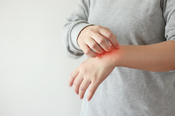 Junge asiatische Frau juckt und kratzt am Arm von juckenden trockenen Hautekzemen Dermatitis - Foto, Bild