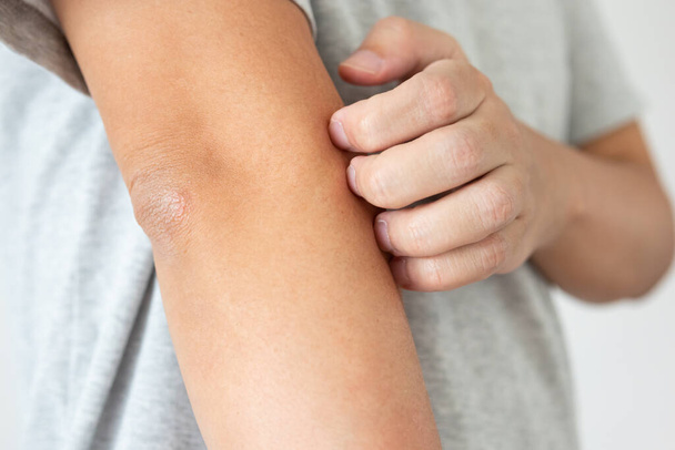 Молодий азіатський чоловік свербить і подряпається на руці від сверблячки сухої шкіри екземи дерматиту
 - Фото, зображення