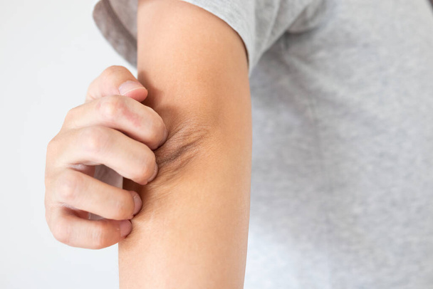 Молодой азиат чешется и царапается на руке от зудящего сухого дерматита кожи - Фото, изображение