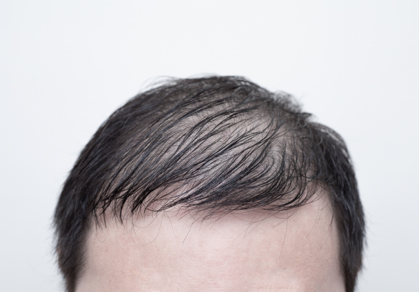 白い背景に隔離された脱毛、薄毛や脱毛症で男の頭を閉じます。髪の問題.  - 写真・画像