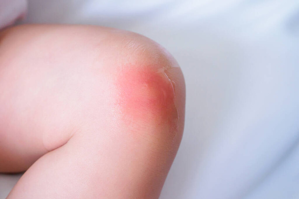 huiduitslag bij baby en allergie met rode vlek veroorzaakt door muggenbeet op de knie  - Foto, afbeelding