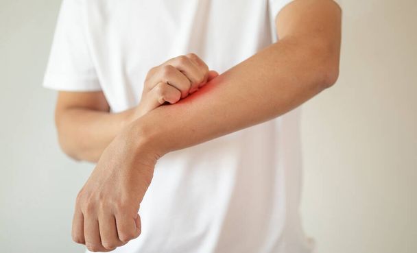 démangeaisons et éraflures de l'homme sur le bras dues à une dermatite cutanée sèche avec démangeaisons eczéma - Photo, image