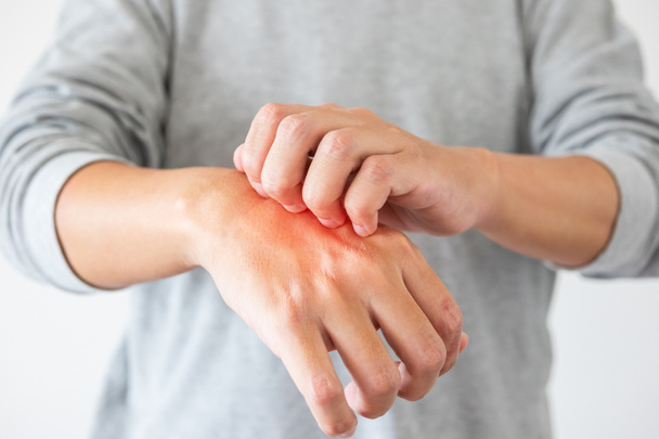 Jeune asiatique homme démangeaisons et grattage sur la main de démangeaisons peau sèche eczéma dermatite - Photo, image