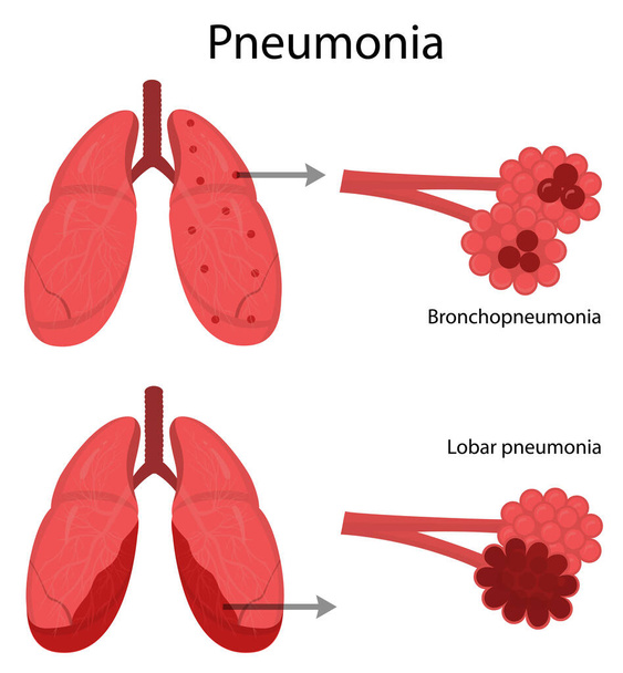 Maladie pulmonaire. Pneumonie. - Vecteur, image