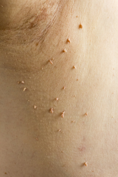 Papilloma virus v lidském podpaží, koncept kožního onemocnění. - Fotografie, Obrázek