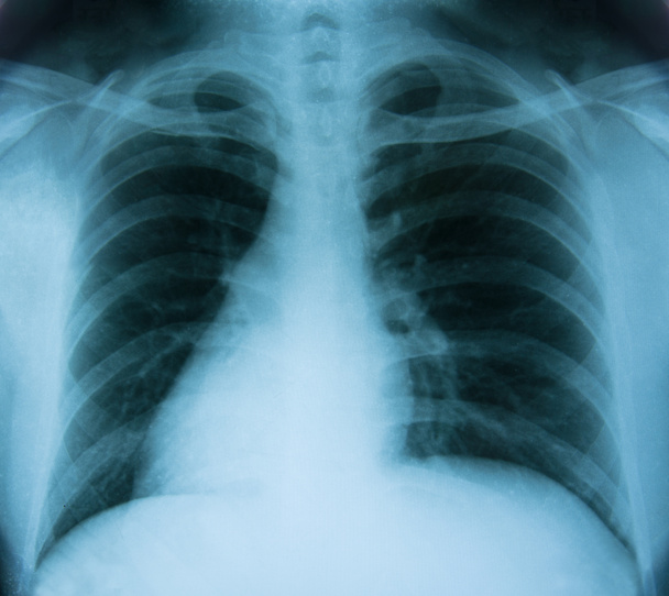 X-Ray Image Of Human Chest - Photo, Image
