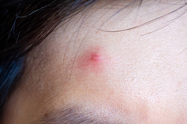 Acné inflamatorio con manchas rojas en el primer plano de la cara - Foto, Imagen