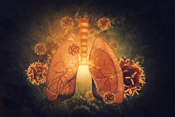 Virus y bacterias infectaron los pulmones humanos. enfermedad pulmonar.3d renderizar - Foto, Imagen