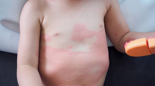 Severe eczema skin rash and allergic reaction symtom at little asian child body cause by hypersensitivity - Photo, Image