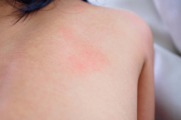 pieni aasialainen tyttö ihottuma ja allergia punaisella paikalla aiheuttaa hyttysen purema takana - Valokuva, kuva