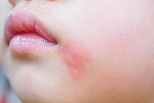 malá asijská dívka kožní vyrážka a alergie s červenou skvrnou příčinu komáří kousnutí do obličeje - Fotografie, Obrázek