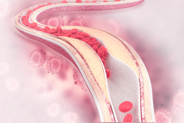 Cholesterin Plaque in der Arterie. 3D-Illustration - Foto, Bild