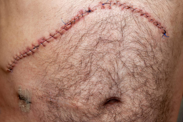 Műtét utáni varrat onkológiai műtét után a májon, hasi műtét, a lyuk bal alsó részén a vízelvezető és egy régi heg a iliosztómiából - Fotó, kép