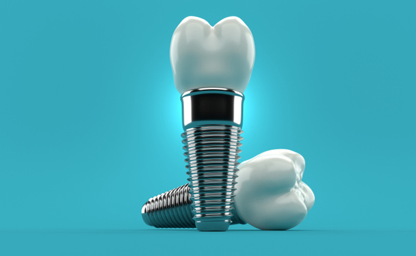 Implantes dentários em fundo azul. ilustração 3d - Foto, Imagem
