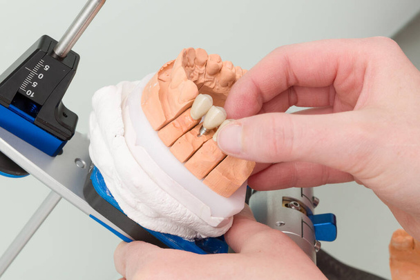 montage van een tandimplantaat op een articulator / prothese zadel - Foto, afbeelding