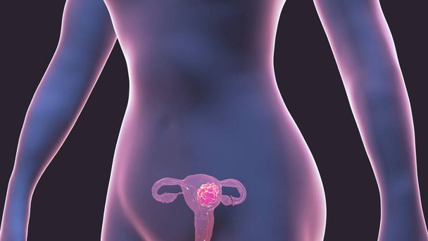Gebärmutterkrebs, 3D-Illustration zeigt bösartigen Tumor in der weiblichen Gebärmutter - Foto, Bild