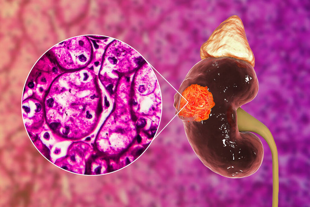 Cáncer de riñón, carcinoma de células renales, ilustración 3D y micrografía ligera - Foto, imagen