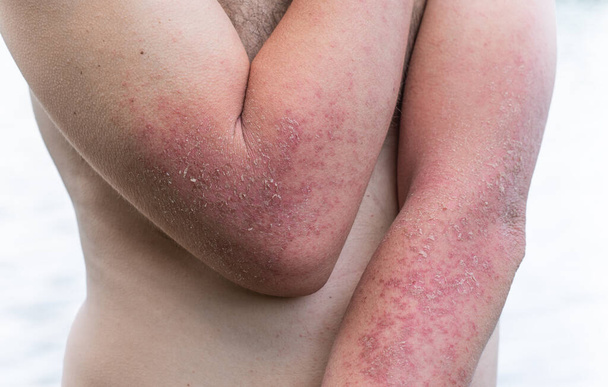 Dyshidrotic autoimmune eczema of patient. Concept of health care - Photo, Image