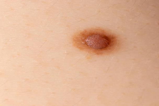 Mole birthmark nevus macro photo on human skin. Close up - Photo, Image
