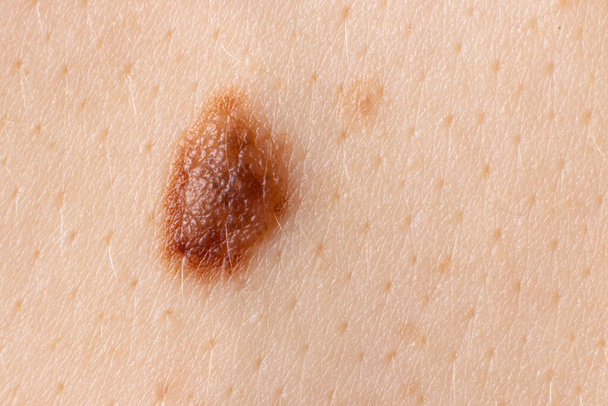 Mole birthmark nevus macro photo on human skin. Close up. - Photo, Image