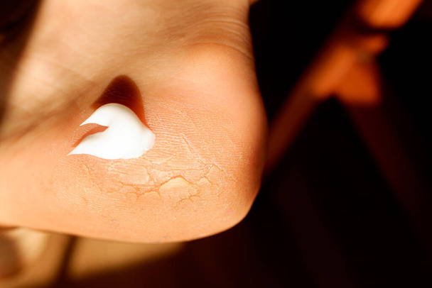 Rissige und trockene Haut an der Ferse des Fußes, die mit einer harnstoffreichen Creme behandelt wird. - Foto, Bild