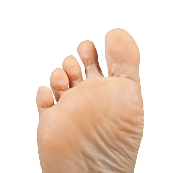 voetschimmel, tinea pedis - Foto, afbeelding