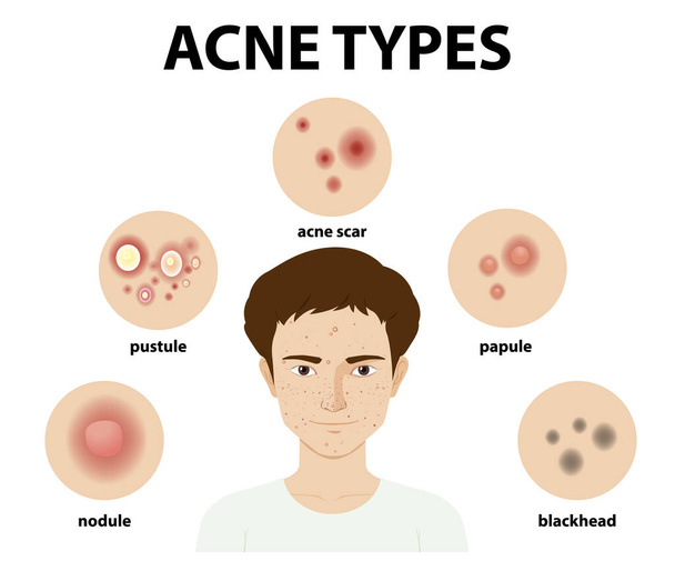 Types d'acné sur la peau ou les boutons illustration - Vecteur, image