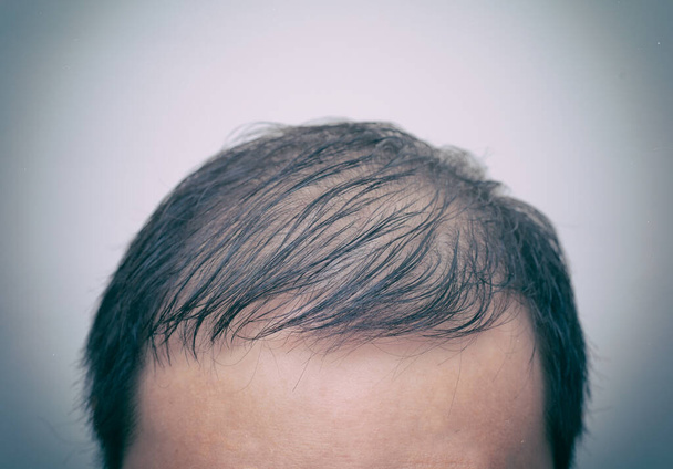 Adamın kafasını saç dökülmesi, seyrelme ya da eski analog film efektiyle beyaz arka planda izole edilmiş saç dökülmesi ile kapat. Saç problemi.. - Fotoğraf, Görsel