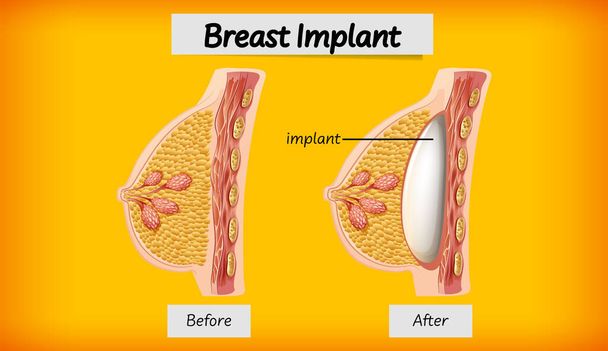Anatomy of human breast implant illustration - Vector, Image