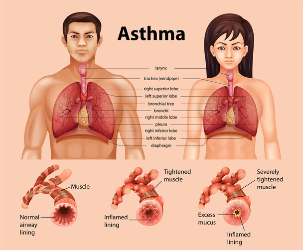 Srovnání zdravých plic a astmatické plicní ilustrace - Vektor, obrázek