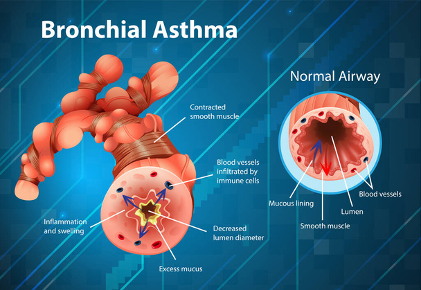 Asthma inflamed bronchial tube illustration - Vector, Image