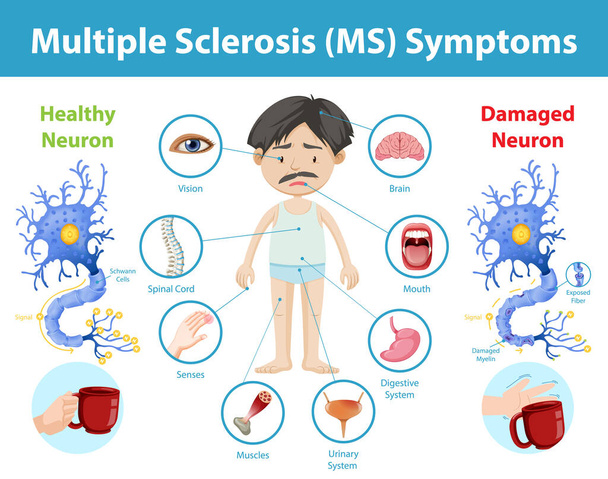 Multiple sclerosis (MS) symptoms information infographic illustration - Vector, Image