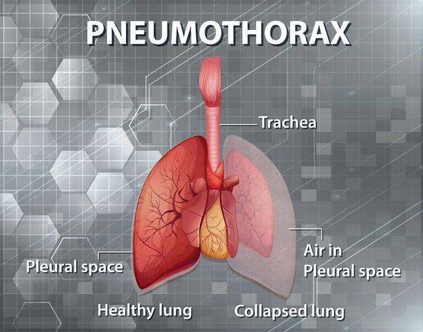 Ilustração informativa da ilustração do pneumotórax - Vetor, Imagem