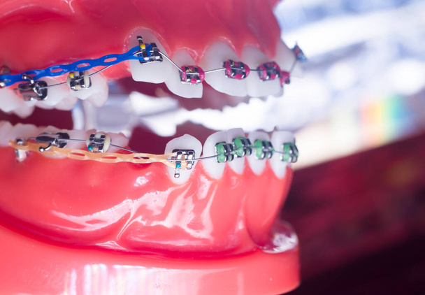 Attaches métalliques modernes et algners en plastique fil consoles dentaires redresseurs de dents
. - Photo, image