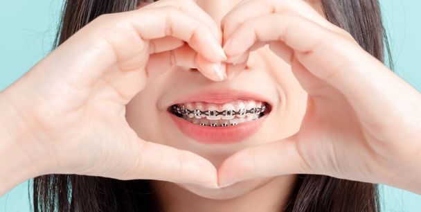 Close up Lover Dental braces of young asian woman wearing braces beauty smile with white teeth increase confidence for healthy on blue background isolated studio shot, Happiness teenager smiling. - Fotó, kép