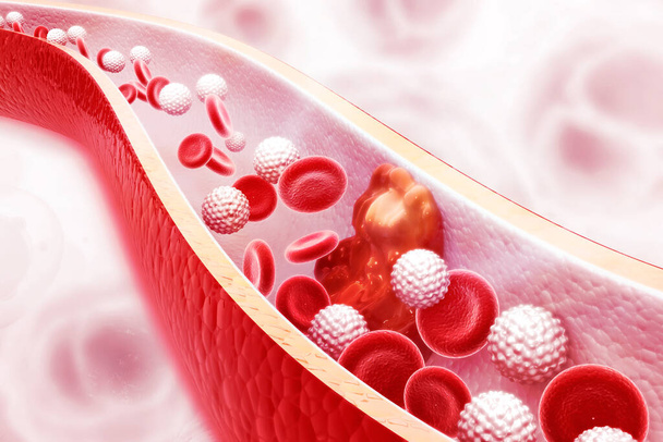 Tablica cholesterolu w tętnicy na tle naukowym. Ilustracja 3D - Zdjęcie, obraz
