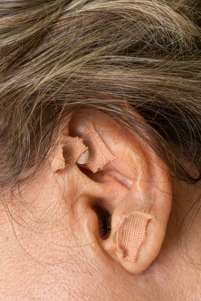 Femme qui a eu un traitement d'acupuncture de l'oreille fait sur son oreille - Photo, image