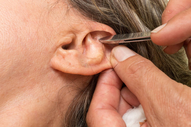 Donna che ha avuto il trattamento di agopuntura dell'orecchio fatto avendo le borchie auricolari rimosso  - Foto, immagini