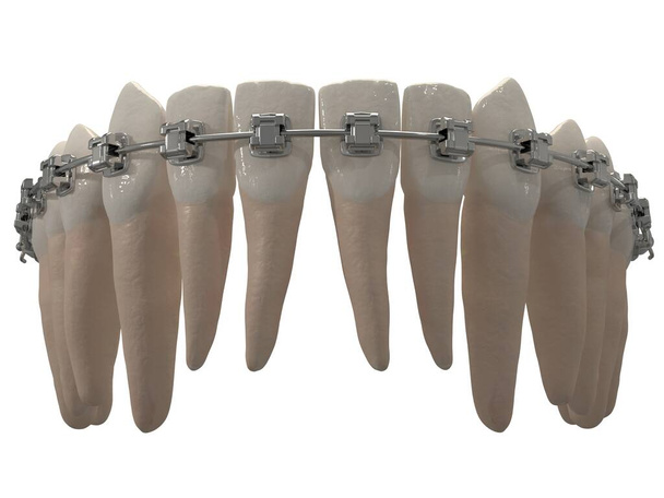 El aparato de ortodoncia extraíble se utiliza después del tratamiento de ortodoncia para la retención. 3d renderizar - Foto, Imagen