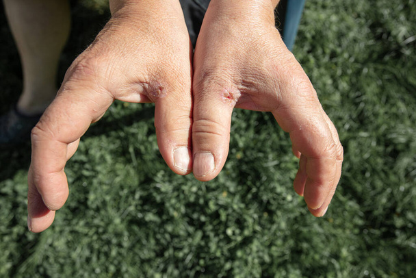 Bőrkeményedések a kezeken, közelkép a férfi kezekről - Fotó, kép