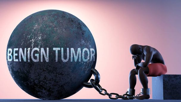 生活の中で重い重量として良性腫瘍-ベナン腫瘍が苦しみを引き起こす可能性があることを示すために囚人ボールに接続されている鎖の人によって象徴され、 3Dイラスト - 写真・画像