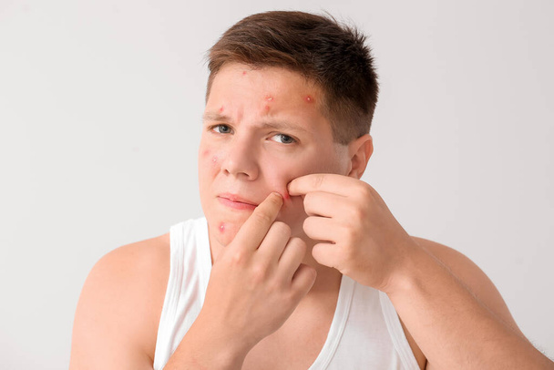 Teenage boy with acne problem squishing pimples on light background - Fotó, kép