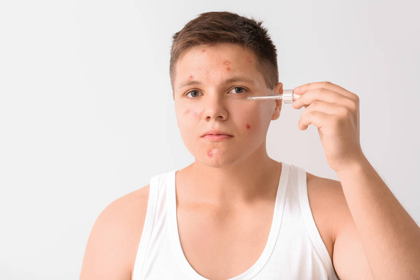Teenage boy with remedy for acne on light background - Photo, Image