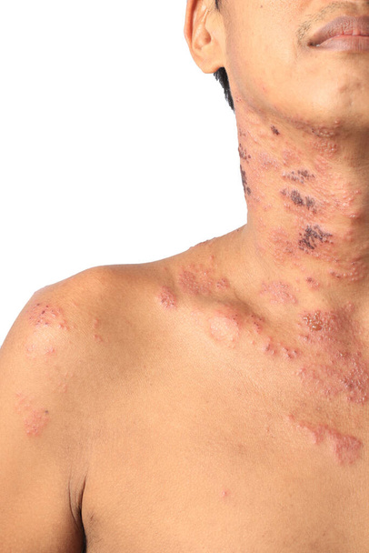 Herpes zoster vagy övsömör vagy Zoster; a tünetet Varicella Zoster vírus vagy VZV fertőzte meg. egy vírusos betegség jellemzi fájdalmas bőrkiütés hólyagokkal egy lokalizált területen. A kiütés fordul elő egy része, széles viszketés oldalán a test - Fotó, kép