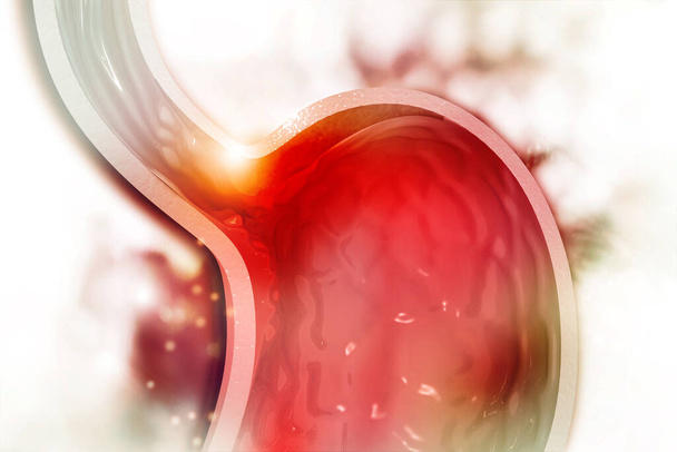 Placca di colesterolo nell'arteria. Sezione dello stomaco. Illustrazione 3d - Foto, immagini