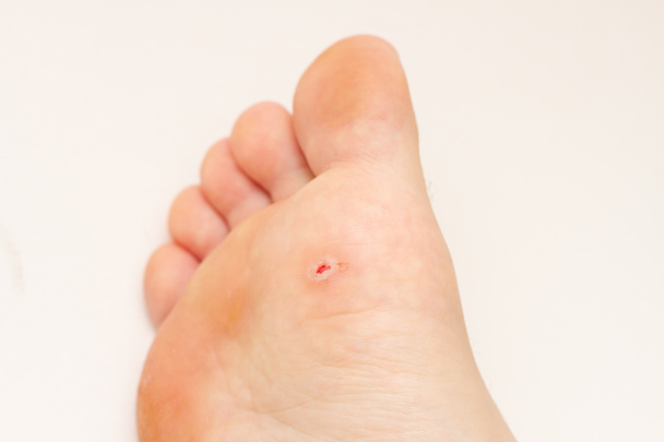 Plantarwarze zu Fuß. Offene Wunde nach der Warzenentfernung an der Fußsohle. Papillomavirus. - Foto, Bild