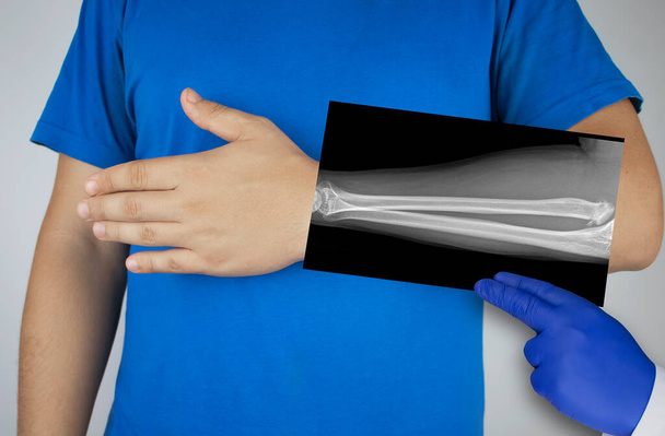 X-ray of a man's forearm. A photograph of the spoke-bone and ulna bones is brought to the patient's hand. Radiologist examine X-ray examination. - Photo, Image